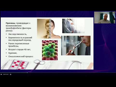 Видео: Тромбофлебит