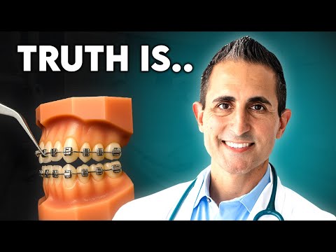 Видео: Самолигирующие брекеты: безболезненное чудо или просто маркетинг?