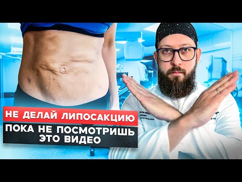 Видео: БУГРЫ после ЛИПОСАКЦИИ | Как их избежать?