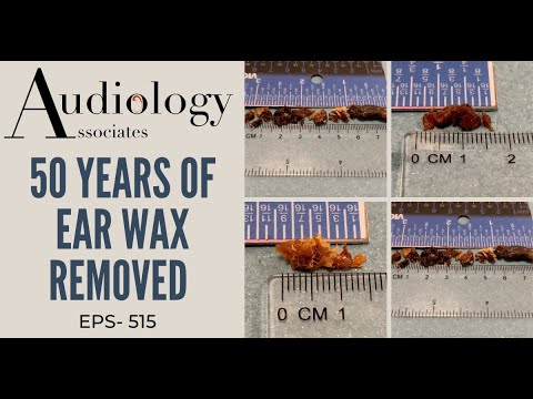 Видео: 50 ЛЕТ УДАЛЕНИЯ УШНОЙ СЕРЫ - EP515
