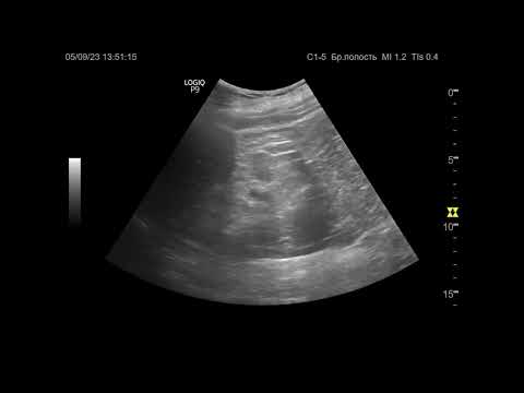 Видео: Ультразвуковая диагностика (УЗИ). Доктор Иогансен. Видеопримеры. Выпуск 35. Нефросклероз.