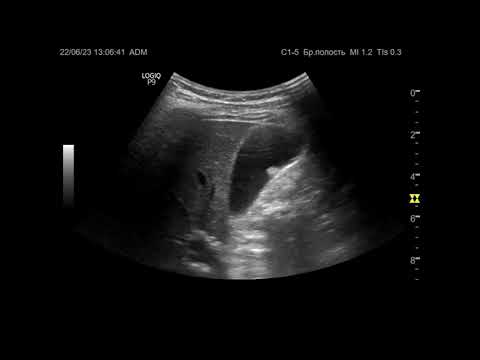 Видео: Ультразвуковая диагностика (УЗИ). Доктор Иогансен. Видеопримеры. Выпуск 25. Полипы желчного пузыря.