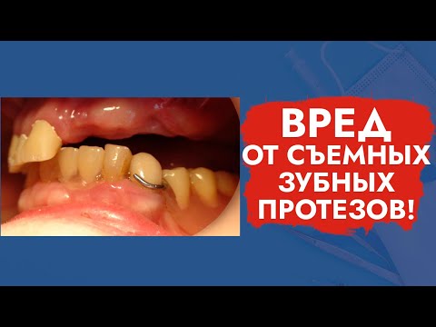 Видео: Вред от съемных зубных протезов!