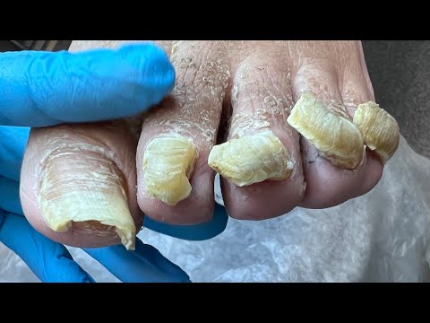 Видео: Онихогрифоз | обработка утолщенных ногтей | история клиента