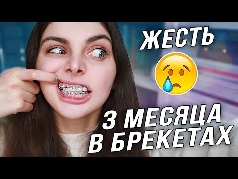 Видео: 3 МЕСЯЦА В БРЕКЕТАХ / Новости и изменения