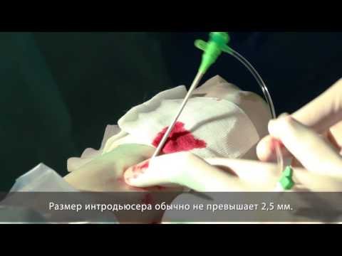 Видео: Стентирование коронарных артерий