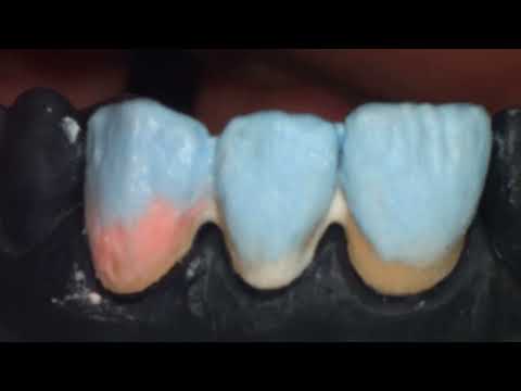 Видео: Емаль