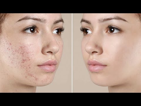 Видео: Анализы перед Роаккутаном (бесплатная лекция)