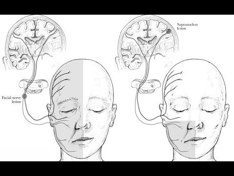 Видео: поражение лицевого нерва