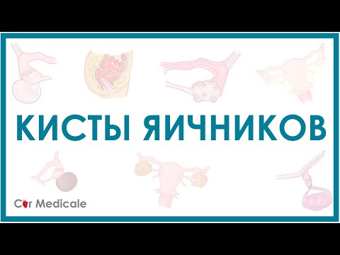 Видео: Кисты яичников: что такое, виды, симптомы, осложнения, принцип лечения