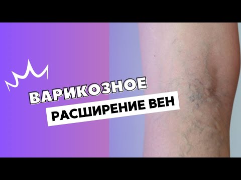 Видео: ВАРИКОЗНОЕ РАСШИРЕНИЕ ВЕН  @DrOlenaB #olenaberezovska #беременность #doctorberezovska