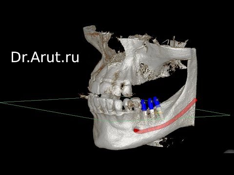 Видео: Планирование имплантации в программе EZ3D2009