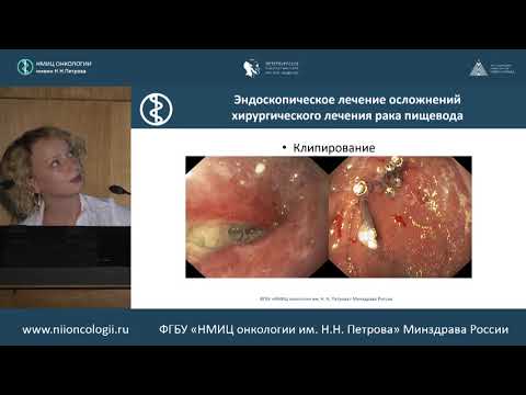 Видео: Эндоскопическое лечение ранних форм и хирургического лечения рака пищевода