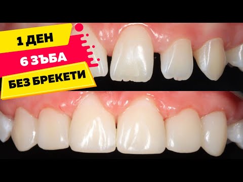 Видео: Бондинг Зъби [Пълна промяна за ден]