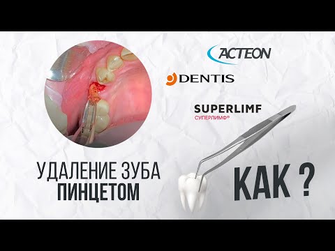 Видео: Пьезохирургическое удаление корня зуба. Одномоментная имплантация. Таргетная иммунокоррекция.