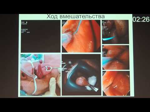 Видео: П06 Удаление фиброваскулярного глоточно пищеводного полипа   Таран А А
