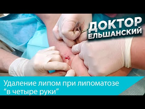 Видео: Удаление липом при липоматозе "в четыре руки"