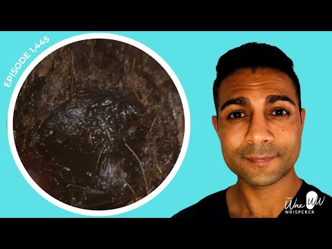 Видео: 1445 — Пациент с тяжёлой серной пробкой в ​​правом ухе и инфекцией «уха пловца» в левом ухе