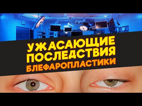 Видео: Ужасающие последствия блефаропластики!