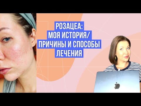 Видео: РОЗАЦЕЯ - МОЯ ИСТОРИЯ/РЕМИССИЯ 3 ГОДА/КАК ЛЕЧИТЬ