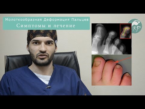 Видео: Молоткообразная Деформация пальцев обо всем @arturtadj