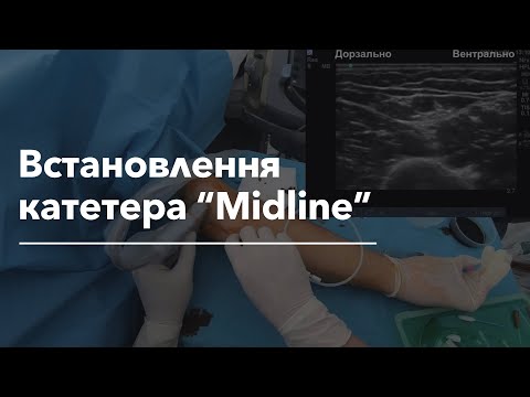 Видео: Встановлення катетера "Midline" | Midline Catheter Placement