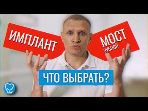 Видео: Имплант или зубной мостик. Что лучше выбрать? Имплантация зубов. Мост зубной | Доктор Коннов