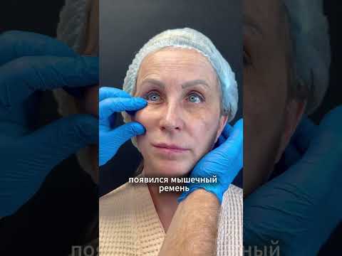 Видео: Как исправить последствия неудачной блефаропластики!
