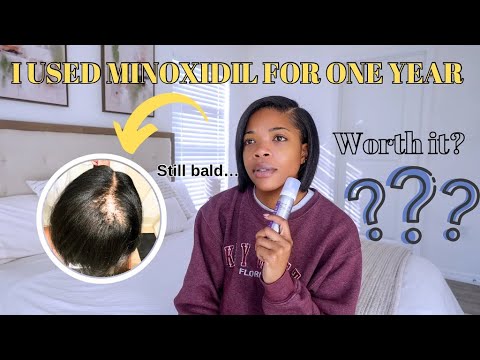 Видео: 1 год использования миноксидила от облысения: мои шокирующие результаты!
