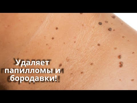 Видео: Дешевые средства ОТ ПАПИЛЛОМ и БОРОДАВОК! Безопасно и просто удалить папилломы и удалить бородавки.