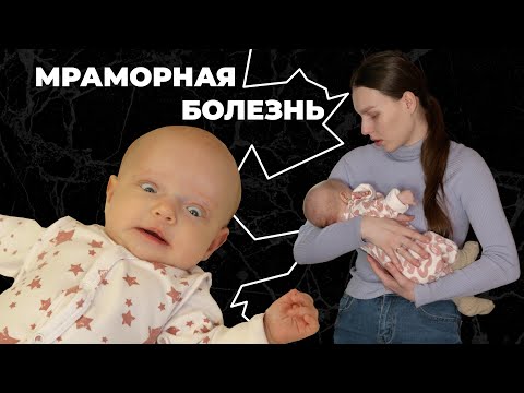 Видео: МРАМОРНАЯ БОЛЕЗНЬ I История Аделины Ертмаковой
