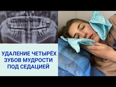 Видео: УДАЛЕНИЕ ЧЕТЫРЁХ ЗУБОВ МУДРОСТИ ПОД СЕДАЦИЕЙ | ЛИЧНЫЙ ОПЫТ