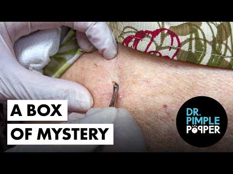 Видео: Доктор Пимпл Поппер открывает коробку с таинственными леденцами