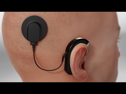 Видео: Кохлеарный имплант (3D-анимация)