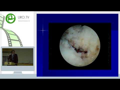 Видео: Болгов Е Н - Лазерная энуклеация аденомы простаты