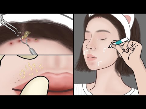 Видео: ASMR Удаление угрей в домашних условиях| DIY Спа для очистки угрей и белых угрей| Meng's Stop Motion