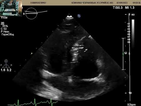 Видео: УЗИ сердца в 19 лет. Что с аортальным клапаном?
