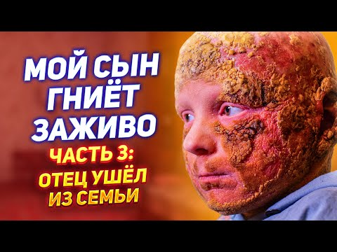 Видео: МОЙ СЫН ГНИЁТ ЗАЖИВО / ОТЕЦ УШЁЛ ИЗ СЕМЬИ / ЧЕШУЯ вместо кожи / Синдром KID, Ихтиоз