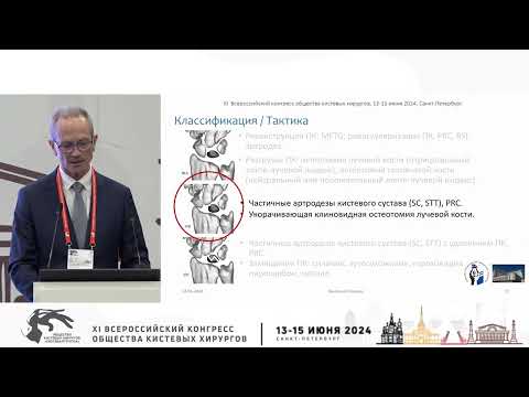Видео: Семенкин О.М.: оперативное лечение пациентов с III стадией болезни Кинбека.