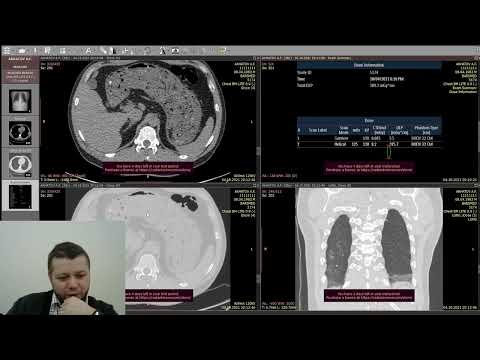 Видео: Сделал КТ легких. Что я увидел на снимках?