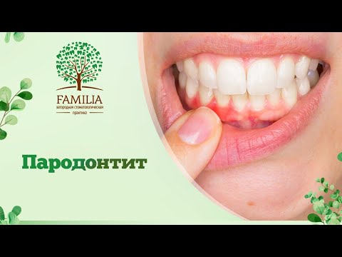 Видео: 😕 Пародонтит / Что такое пародонтит и причины возникновения / Можно ли вылечить пародонтит?