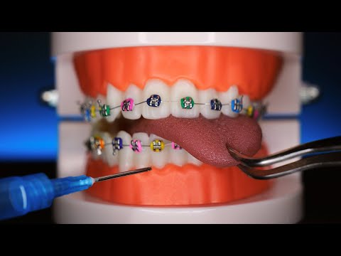 Видео: ASMR Зубной камень, удаление зуба, лечение 🦷 / Довольный стоматолог ролевая игра (субтитры, пирсинг)
