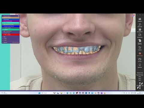 Видео: Изготовление шаблона для гингивопластики в программе exocad