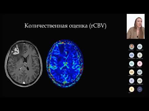 Видео: Нейропротокол в онкологии.  Основа-перфузия.