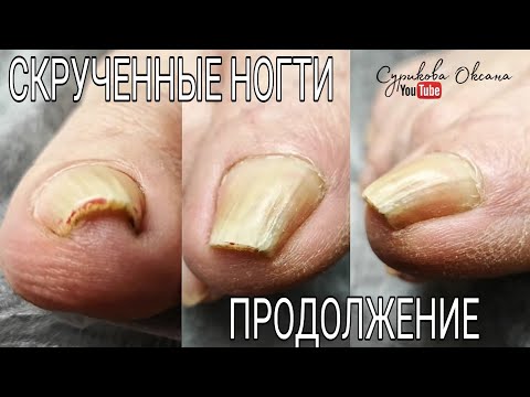 Видео: Скрученные ногти на ногах. Трещина на ногте. Классический возрастной педикюр с покрытием лаком