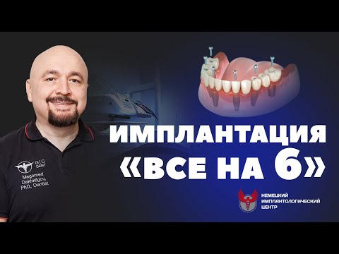 Видео: "ВСЕ НА 6" или ALL ON 6 - мнение эксперта с 27-летним опытом в имплантации
