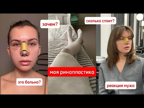 Видео: Моя ринопластика | дневник реабилитации