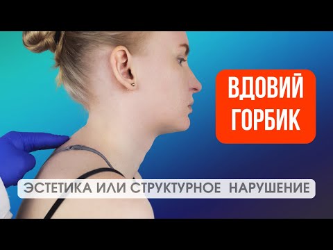 Видео: Два лучших упражнения от вдовьего горбика