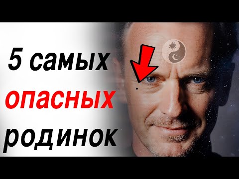 Видео: Что скрывает ваша кожа? Родинка на лбу или шее