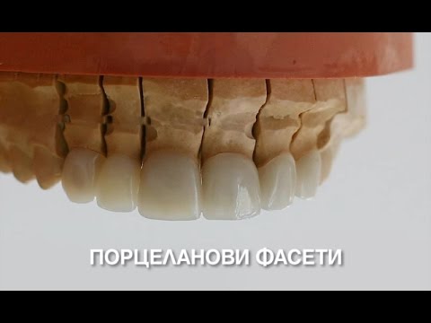 Видео: Порцеланови фасети - стъпка по стъпка